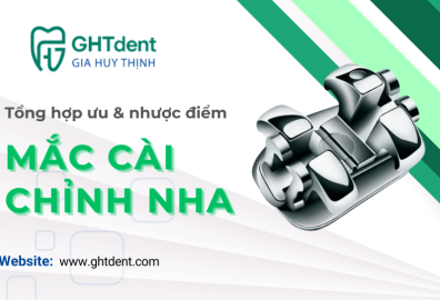 Tổng hợp ưu và nhược điểm của các loại mắc cài chỉnh nha trong niềng răng